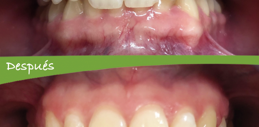 Dentista Calatayud : Caso corregido ortodoncia invisible