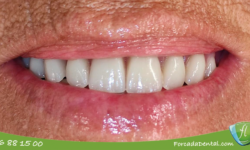 Rehabilitación completa con implantes