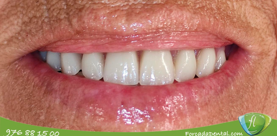 Rehabilitación completa con implantes