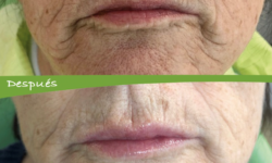 Corrección de arrugas peribucales y perfilado labial