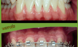 Corrección mordida cruzada anterior