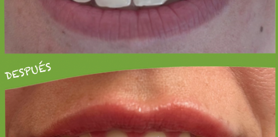 Relleno, perfilado y corrección de asimetrías labiales.